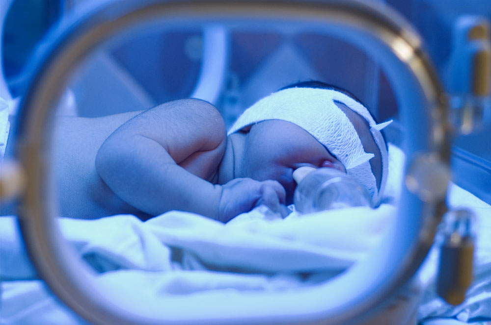 Baby with jaundice laying in an incubator